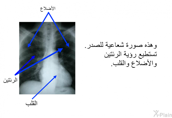 وهذه صورة شعاعية للصدر. تستطيع رؤية الرئتين والأضلاع والقلب.