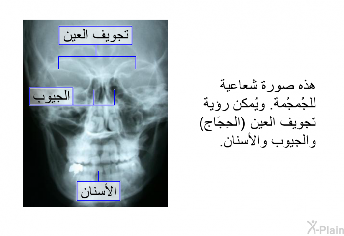 هذه صورة شعاعية للجُمجُمة<B>. </B>ويُمكن رؤية تجويف العين <B>(</B>الحِجَاج<B>) </B>والجيوب والأسنان<B>.</B>