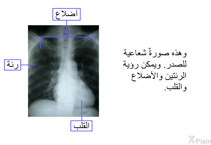 وهذه صورةٌ شعاعية للصدر<B>. </B>ويمكن رؤية الرئتين والأضلاع والقلب<B>.</B>