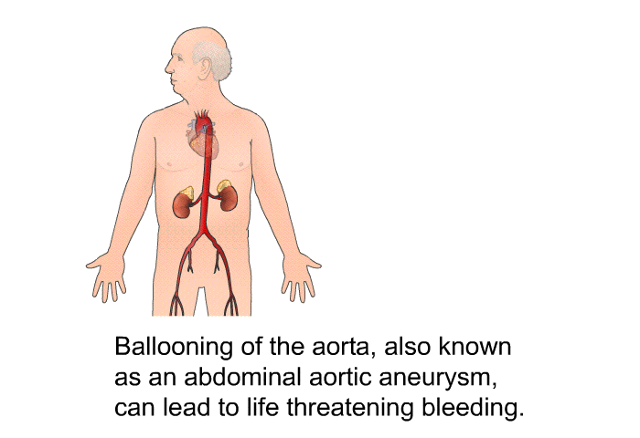 Ballooning of the aorta, also known as an abdominal aortic aneurysm, can lead to life threatening bleeding.