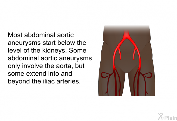 Most abdominal aortic aneurysms start below the level of the kidneys. Some abdominal aortic aneurysms only involve the aorta, but some extend into and beyond the iliac arteries.