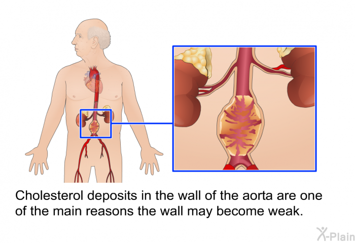 Cholesterol deposits in the wall of the aorta are one of the main reasons the wall may become weak.
