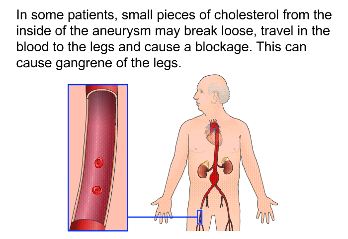In some patients, small pieces of cholesterol from the inside of the aneurysm may break loose, travel in the blood to the legs and cause a blockage. This can cause gangrene of the legs.
