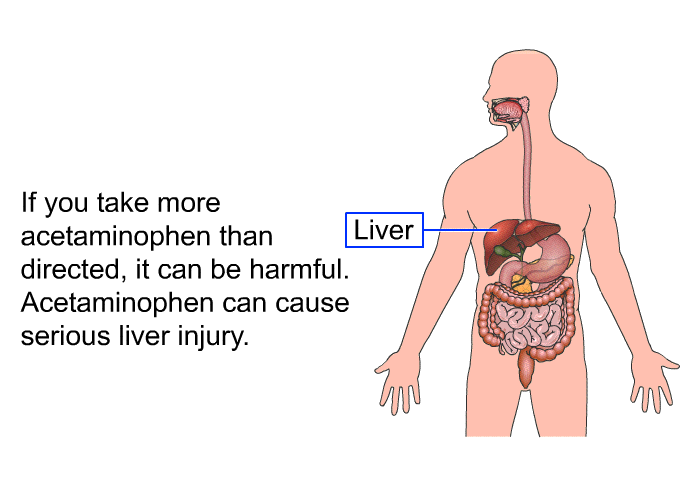 If you take more acetaminophen than directed, it can be harmful. Acetaminophen can cause serious liver injury.