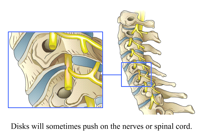 Disks will sometime push on the nerves or spinal cord.