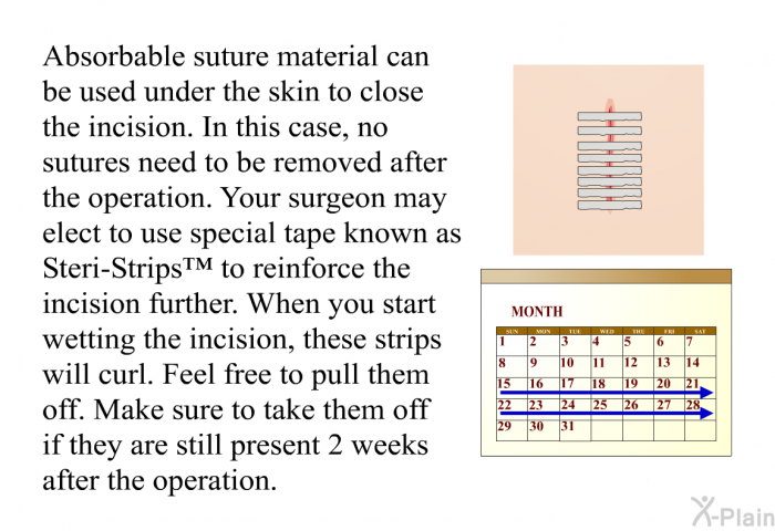 Absorbable suture material can be used under the skin to close the incision. In this case, no sutures need to be removed after the operation. Your surgeon may elect to use special tape known as Steri-Strips™ to reinforce the incision further. When you start wetting the incision, these strips will curl. Feel free to pull them off. Make sure to take them off if they are still present 2 weeks after the operation.