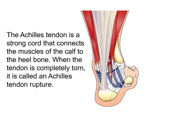 The Achilles tendon is a strong cord that connects the muscles of the calf to the heel bone. When the tendon is completely torn, it is called an Achilles tendon rupture.