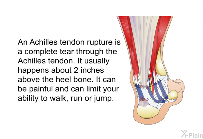 An Achilles tendon rupture is a complete tear through the Achilles tendon. It usually happens about 2 inches above the heel bone. It can be painful and can limit your ability to walk, run or jump.