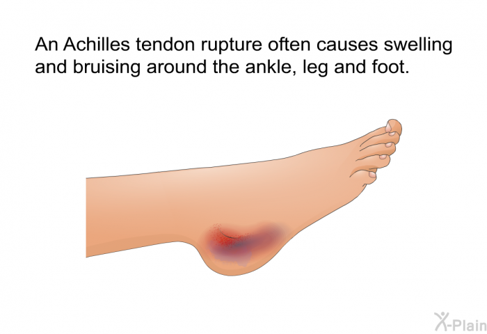 An Achilles tendon rupture often causes swelling and bruising around the ankle, leg and foot.