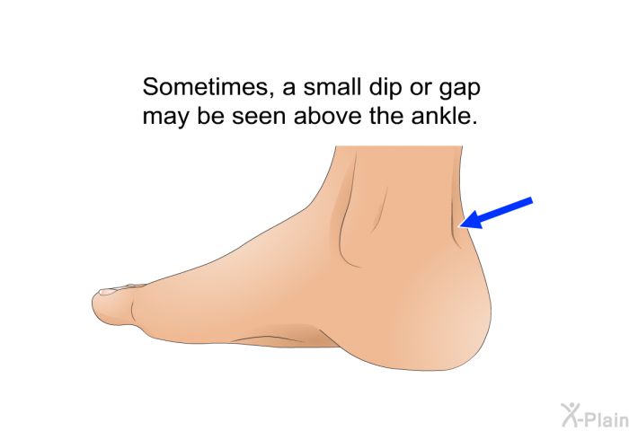 Sometimes, a small dip or gap may be seen above the ankle.