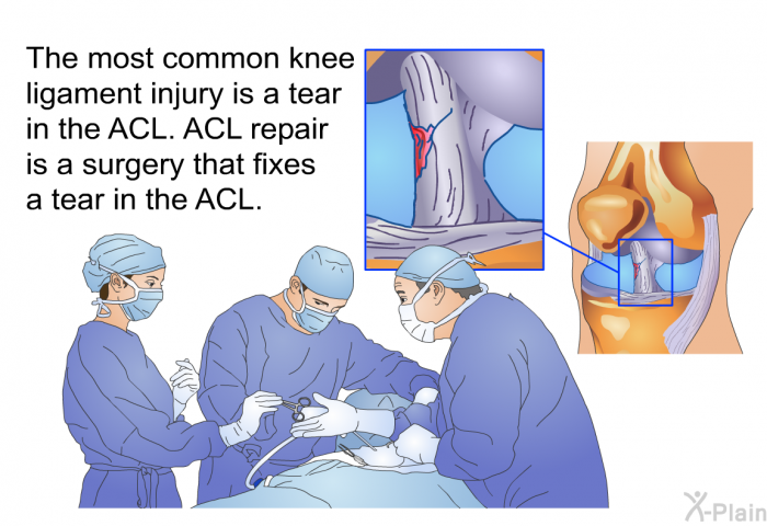 The most common knee ligament injury is a tear in the ACL. ACL repair is a surgery that fixes a tear in the ACL.