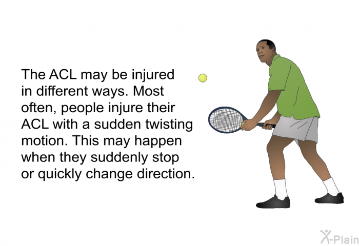 The ACL may be injured in different ways. Most often, people injure their ACL with a sudden twisting motion. This may happen when they suddenly stop or quickly change direction.