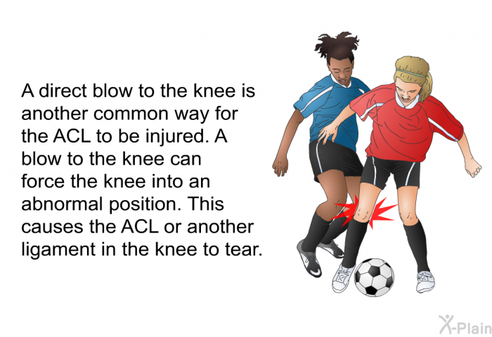 A direct blow to the knee is another common way for the ACL to be injured. A blow to the knee can force the knee into an abnormal position. This causes the ACL or another ligament in the knee to tear.