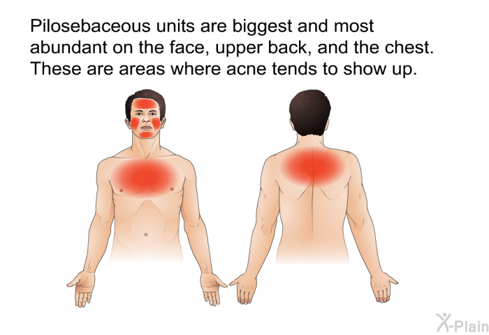 Pilosebaceous units are biggest and most abundant on the face, upper back, and the chest. These are areas where acne tends to show up.