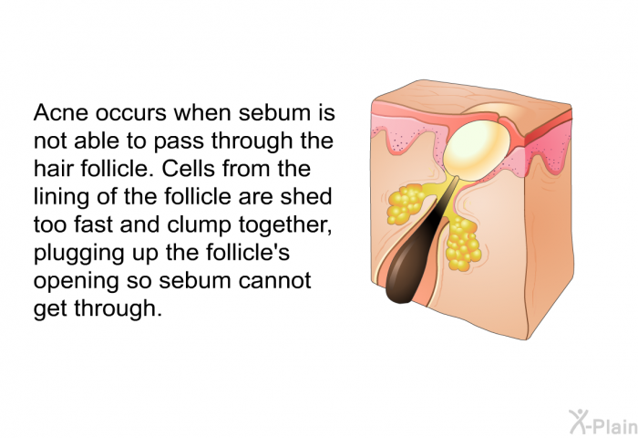 Acne occurs when sebum is not able to pass through the hair follicle. Cells from the lining of the follicle are shed too fast and clump together, plugging up the follicle's opening so sebum cannot get through.