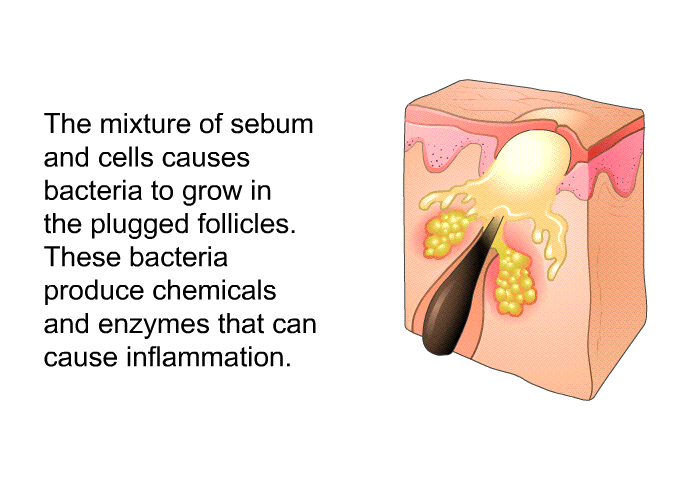 The mixture of sebum and cells causes bacteria to grow in the plugged follicles. These bacteria produce chemicals and enzymes that can cause inflammation.