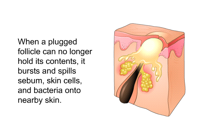 When a plugged follicle can no longer hold its contents, it bursts and spills sebum, skin cells, and bacteria onto nearby skin.