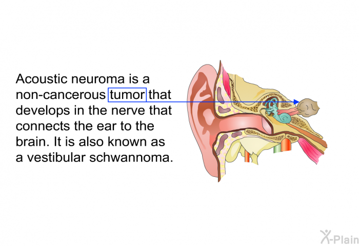 Acoustic neuroma is a non-cancerous tumor that develops in the nerve that connects the ear to the brain. It is also known as a vestibular schwannoma.
