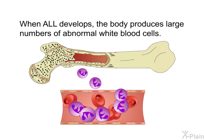 When ALL develops, the body produces large numbers of abnormal white blood cells.