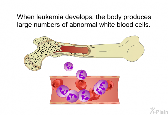 When leukemia develops, the body produces large numbers of abnormal white blood cells.