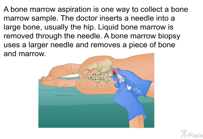 A bone marrow aspiration is one way to collect a bone marrow sample. The doctor inserts a needle into a large bone, usually the hip. Liquid bone marrow is removed through the needle. A bone marrow biopsy uses a larger needle and removes a piece of bone and marrow.