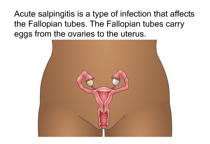 Acute salpingitis is a type of infection that affects the Fallopian tubes. The Fallopian tubes carry eggs from the ovaries to the uterus.