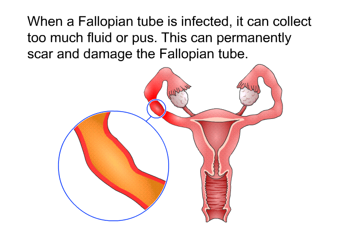 When a Fallopian tube is infected, it can collect too much fluid or pus. This can permanently scar and damage the Fallopian tube.