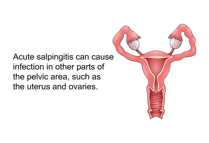 Acute salpingitis can cause infection in other parts of the pelvic area, such as the uterus and ovaries.