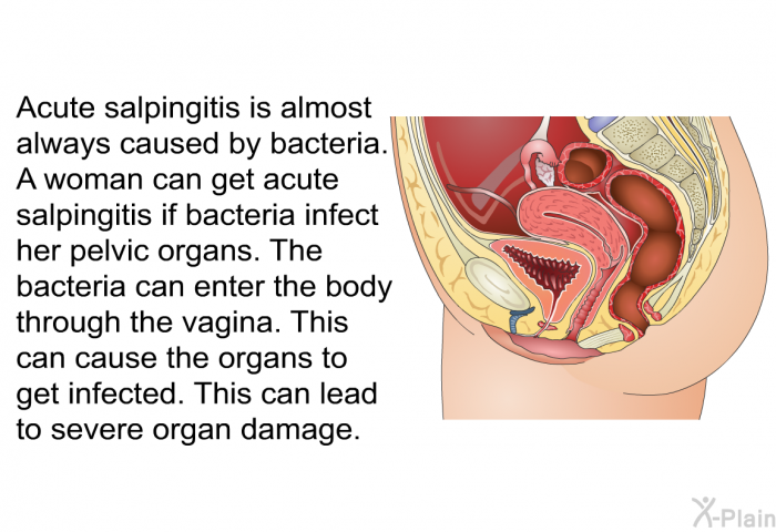 Acute salpingitis is almost always caused by bacteria. A woman can get acute salpingitis if bacteria infect her pelvic organs. The bacteria can enter the body through the vagina. This can cause the organs to get infected. This can lead to severe organ damage.