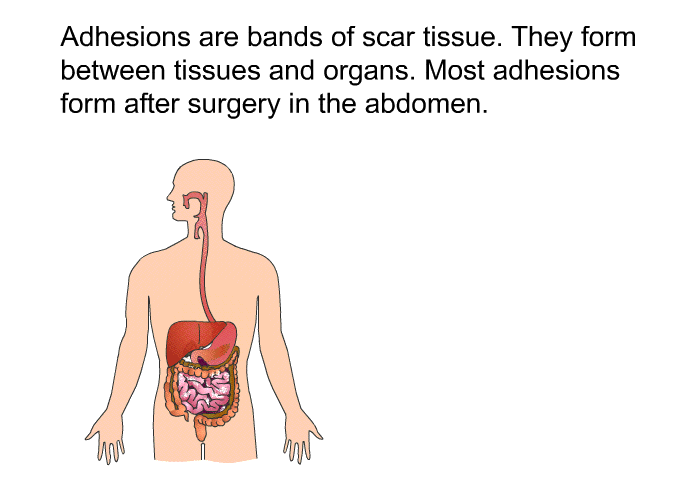 Adhesions are bands of scar tissue. They form between tissues and organs. Most adhesions form after surgery in the abdomen.