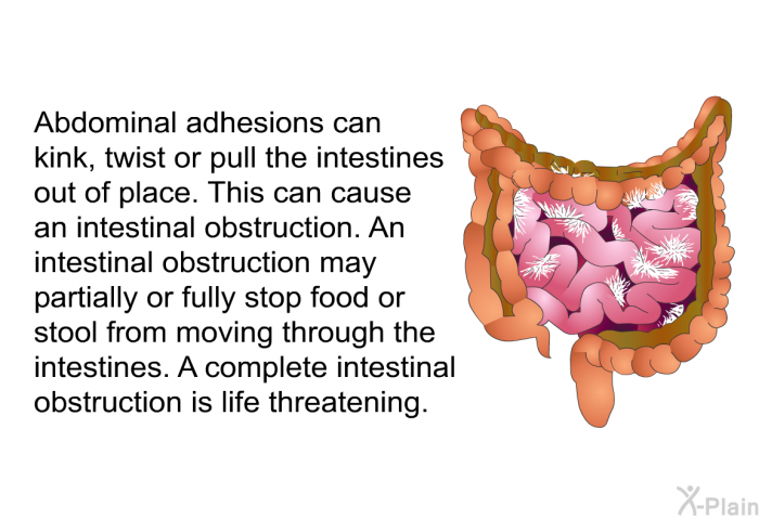Abdominal adhesions can kink, twist or pull the intestines out of place. This can cause an intestinal obstruction. An intestinal obstruction may partially or fully stop food or stool from moving through the intestines. A complete intestinal obstruction is life threatening.