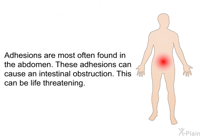 Adhesions are most often found in the abdomen. These adhesions can cause an intestinal obstruction. This can be life threatening.