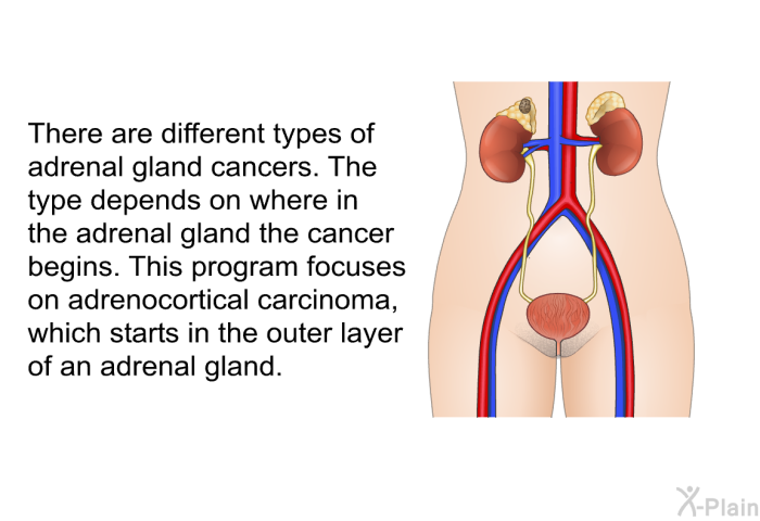 There are different types of adrenal gland cancers. The type depends on where in the adrenal gland the cancer begins. This program focuses on adrenocortical carcinoma, which starts in the outer layer of an adrenal gland.