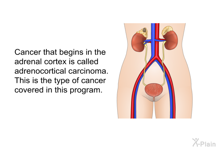 Cancer that begins in the adrenal cortex is called adrenocortical carcinoma. This is the type of cancer covered in this program.