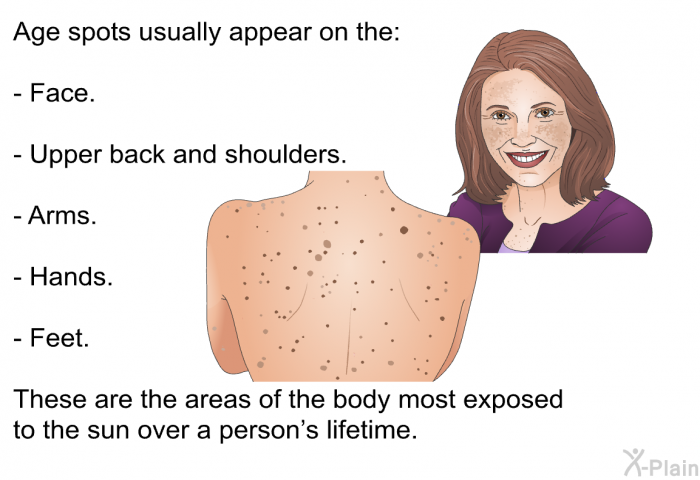 Age spots usually appear on the:  Face. Upper back and shoulders. Arms. Hands. Feet.  
 These are the areas of the body most exposed to the sun over a person's lifetime.