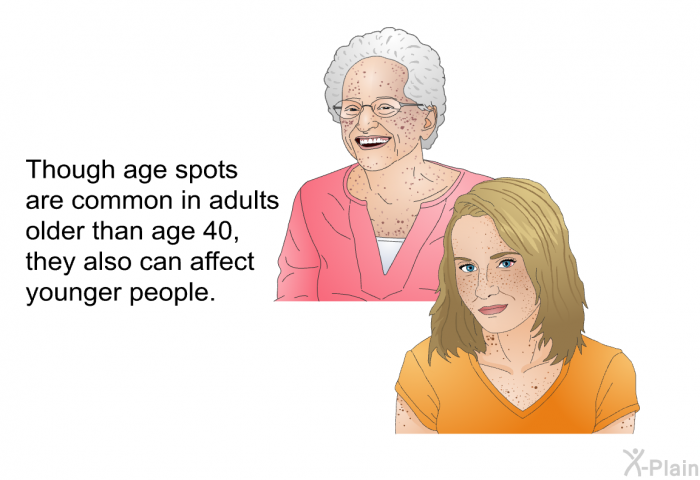 Though age spots are common in adults older than age 40, they also can affect younger people.