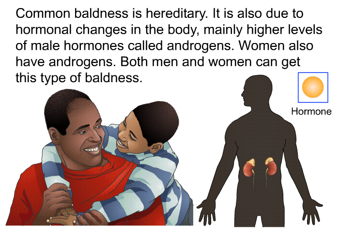 Common baldness is hereditary. It is also due to hormonal changes in the body, mainly higher levels of male hormones called androgens. Women also have androgens. Both men and women can get this type of baldness.