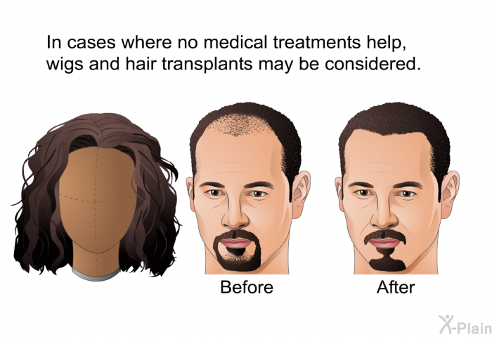 In cases where no medical treatments help, wigs and hair transplants may be considered.