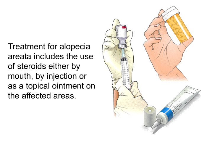 Treatment for alopecia areata includes the use of steroids either by mouth, by injection or as a topical ointment on the affected areas.