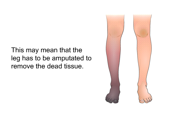 This may mean that the leg has to be amputated to remove the dead tissue.