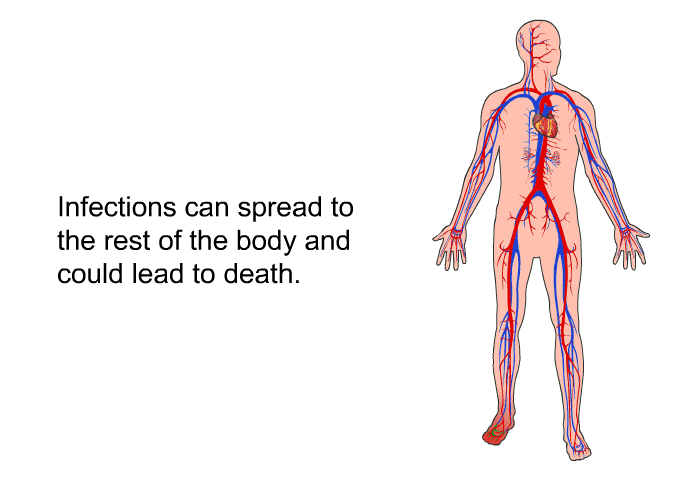 Infections can spread to the rest of the body and could lead to death.