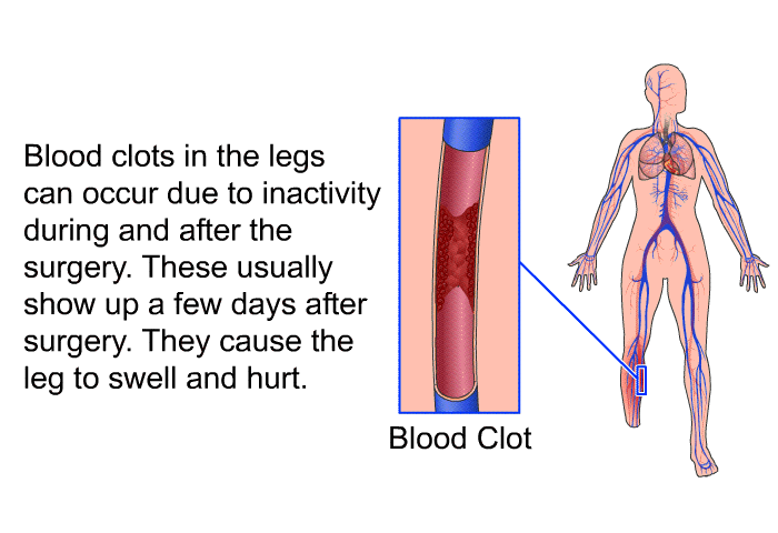 Blood clots in the legs can occur due to inactivity during and after the surgery. These usually show up a few days after surgery. They cause the leg to swell and hurt.