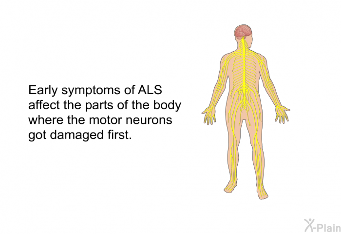 Early symptoms of ALS affect the parts of the body where the motor neurons got damaged first.