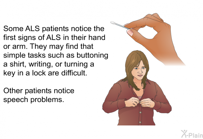 Some ALS patients notice the first signs of ALS in their hand or arm. They may find that simple tasks such as buttoning a shirt, writing or turning a key in a lock are difficult. Other patients notice speech problems.