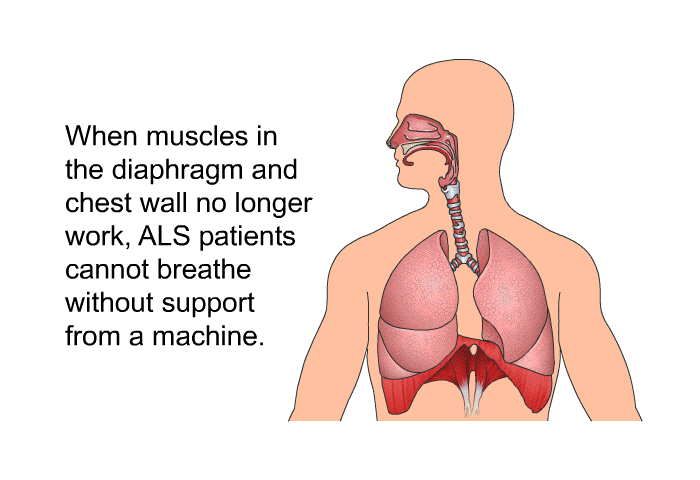 When muscles in the diaphragm and chest wall no longer work, ALS patients cannot breathe without support from a machine.