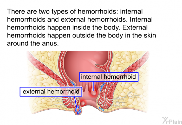 There are two types of hemorrhoids: internal hemorrhoids and external hemorrhoids. Internal hemorrhoids happen inside the body. External hemorrhoids happen outside the body in the skin around the anus.