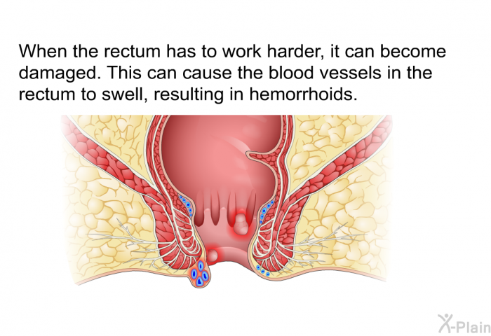 When the rectum has to work harder, it can become damaged. This can cause the blood vessels in the rectum to swell, resulting in hemorrhoids.
