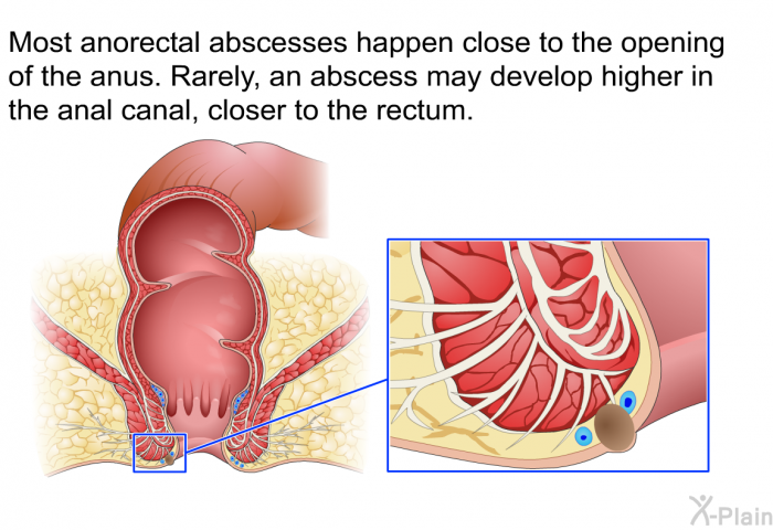 Most anorectal abscesses happen close to the opening of the anus. Rarely, an abscess may develop higher in the anal canal, closer to the rectum.