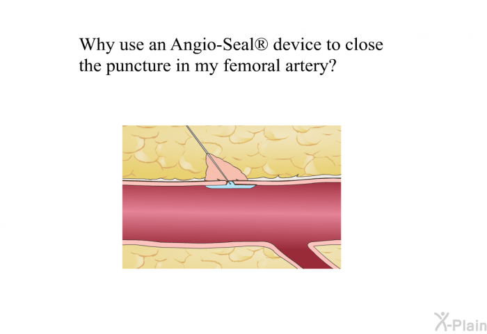 Why use an Angio-Seal<SUP> </SUP> device to close the puncture in my femoral artery?
