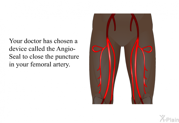 Your doctor has chosen a device called the Angio-Seal to close the puncture in your femoral artery.